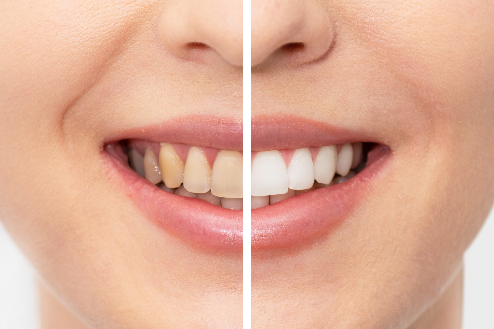 Clareamento Dental: Ilumine Seu Sorriso com Segurança