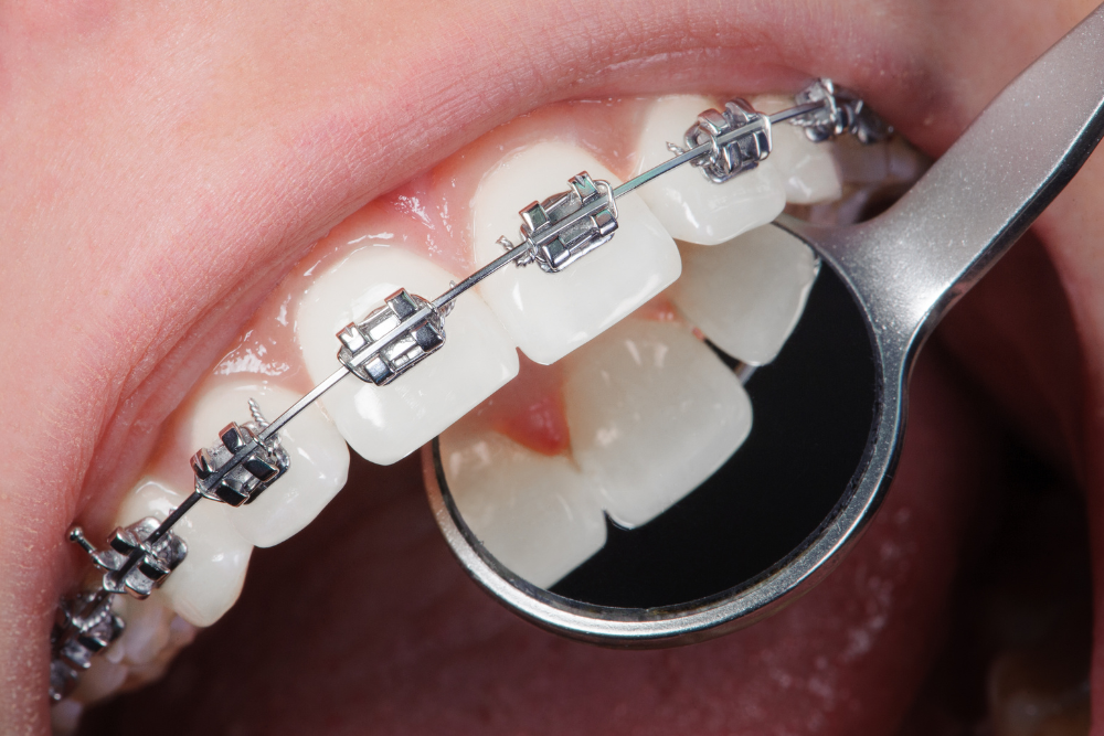 Ortodontia: A Chave para um Sorriso Alinhado e Saudável